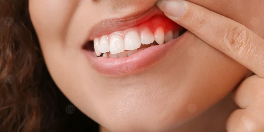 تنظيف الأسنان وعلاج اللثة