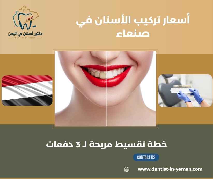 أسعار تركيب الأسنان في صنعاء