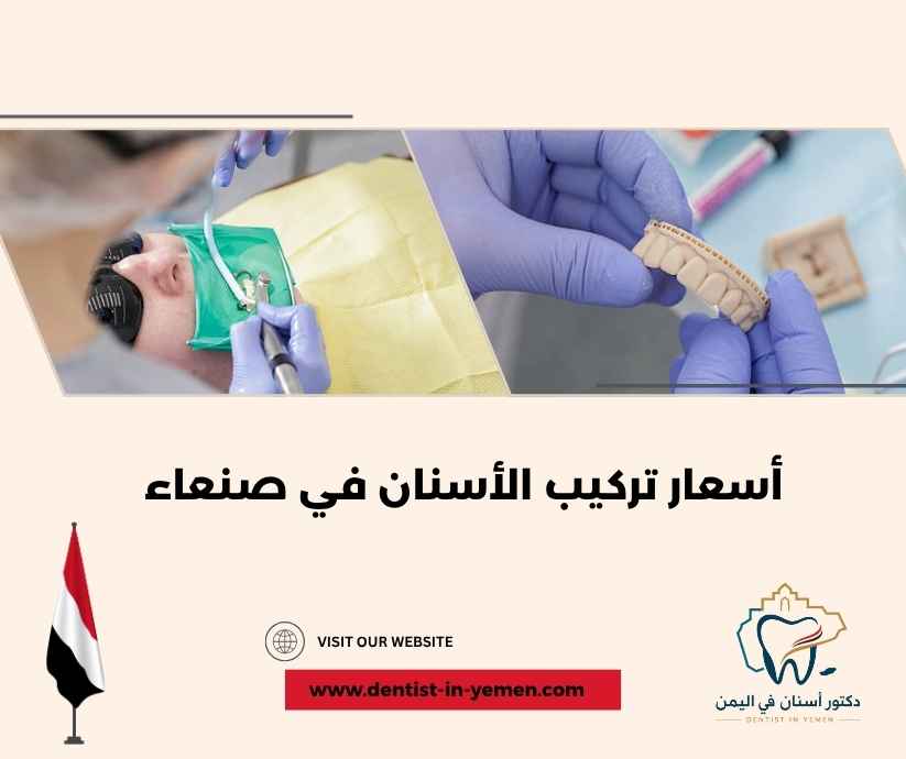 أسعار تركيب الأسنان في صنعاء أسعار تركيب الأسنان في صنعاء