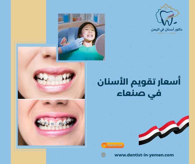 أسعار تقويم الأسنان في صنعاء