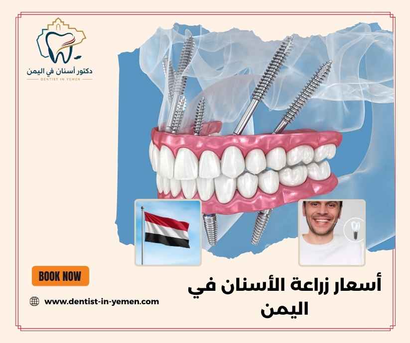 أسعار زراعة الأسنان في اليمن أسعار زراعة الأسنان في اليمن