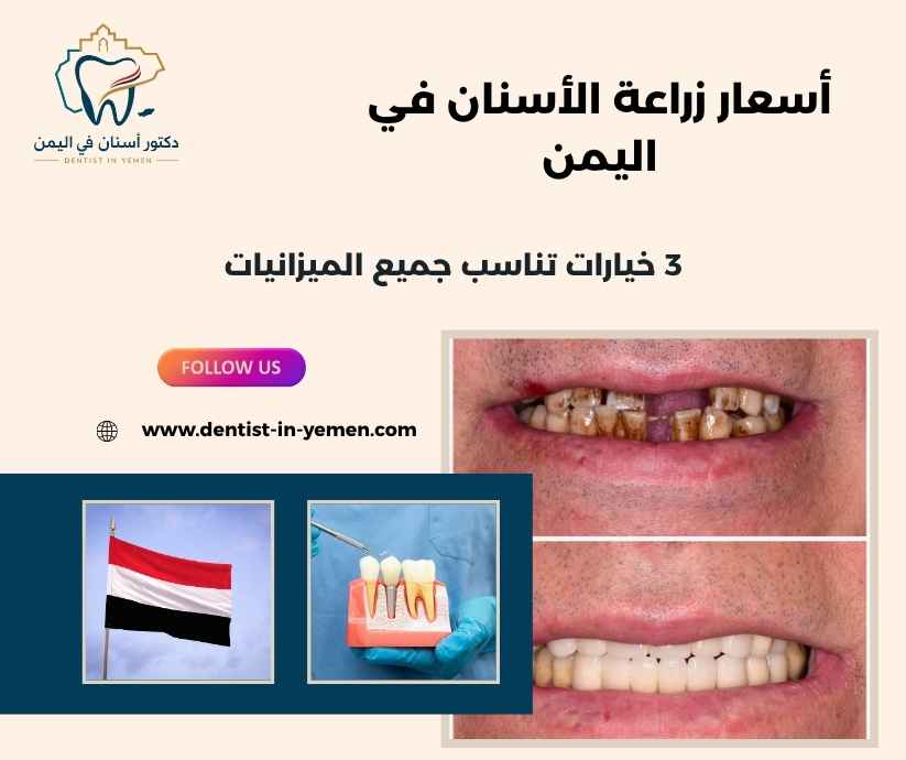 أسعار زراعة الأسنان في اليمن