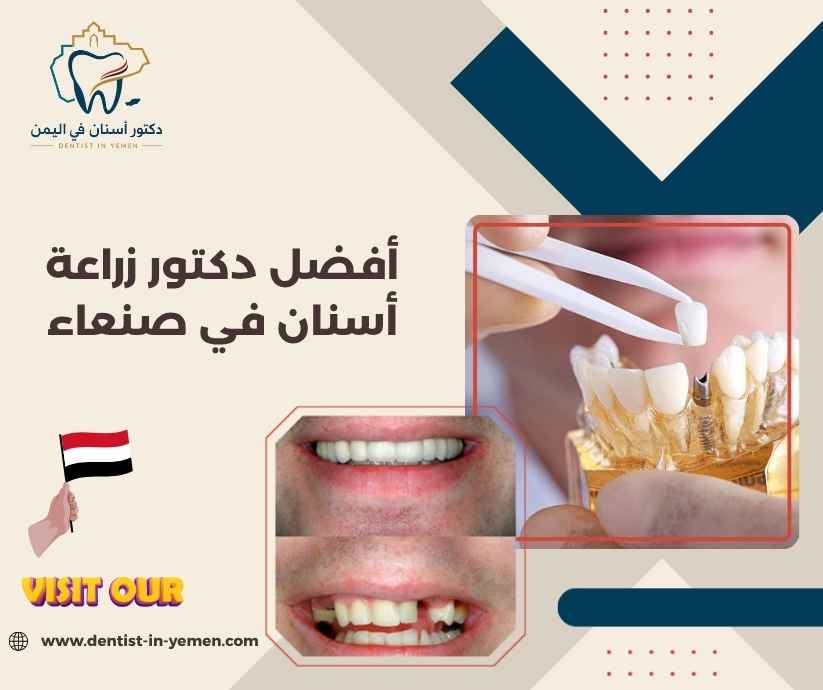 أفضل دكتور زراعة أسنان في صنعاء
