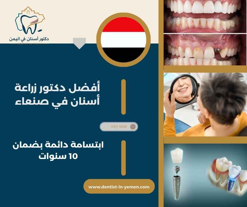 أفضل دكتور زراعة أسنان في صنعاء