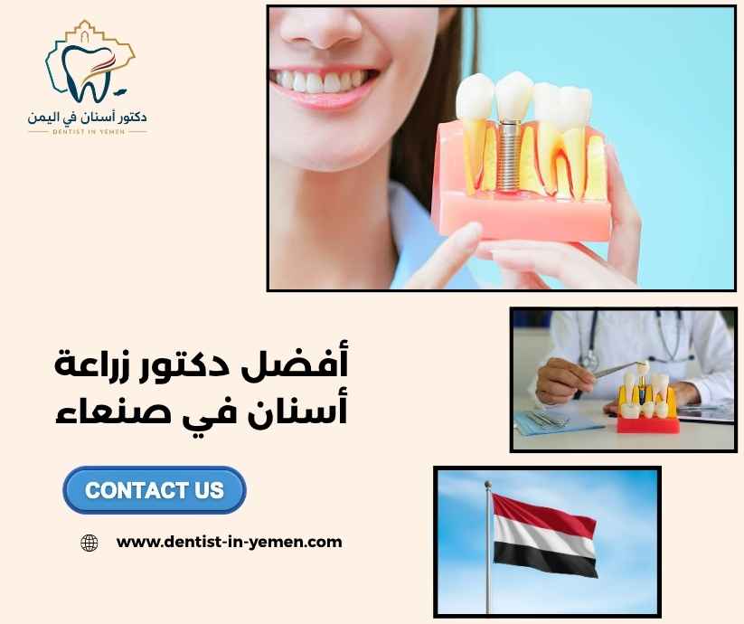 أفضل دكتور زراعة أسنان في صنعاء