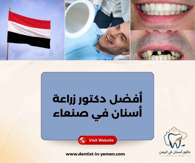 أفضل دكتور زراعة أسنان في صنعاء
