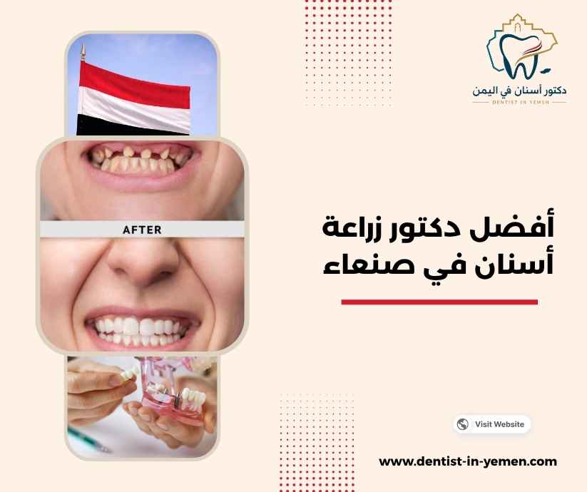 أفضل دكتور زراعة أسنان في صنعاء