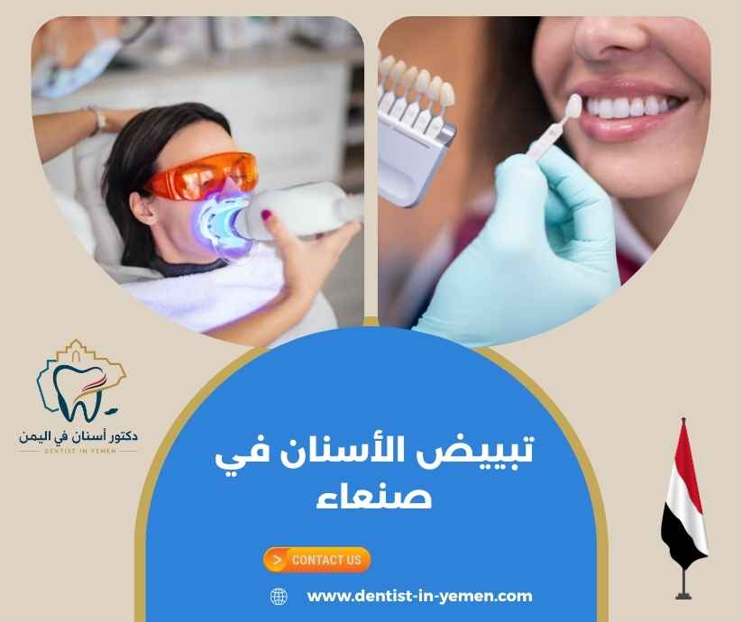 تبييض الأسنان في صنعاء