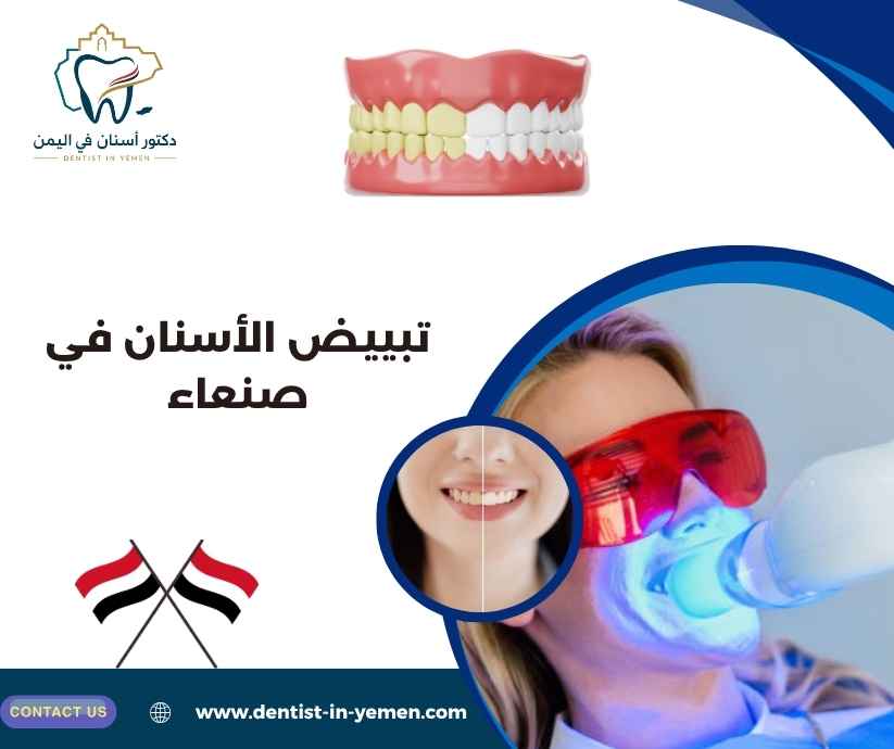 تبييض الأسنان في صنعاء