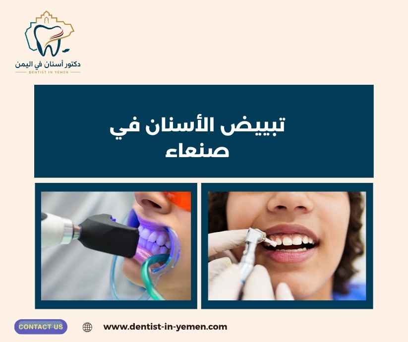 تبييض الأسنان في صنعاء