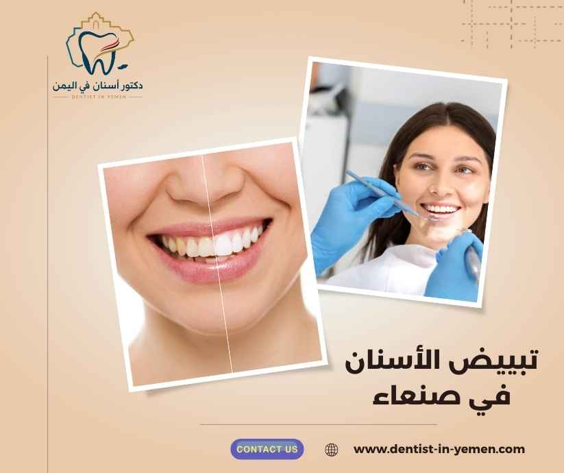 تبييض الأسنان في صنعاء