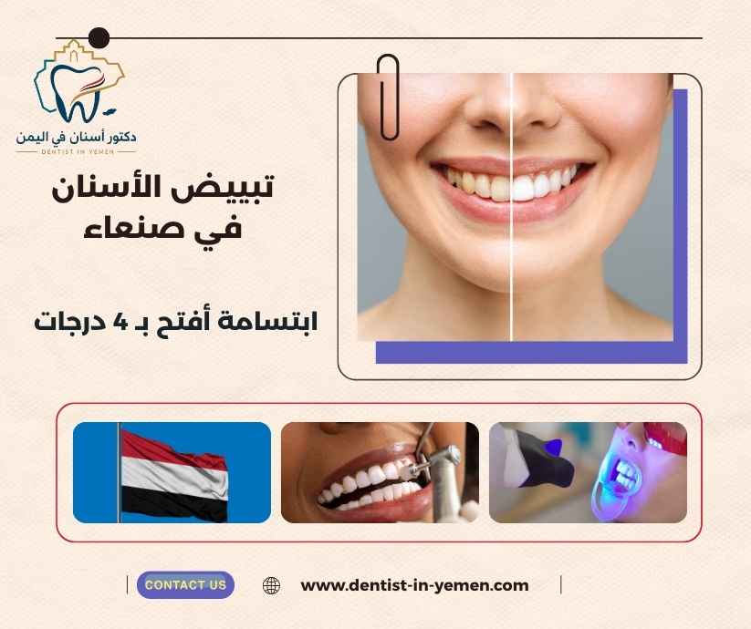 تبييض الأسنان في صنعاء
