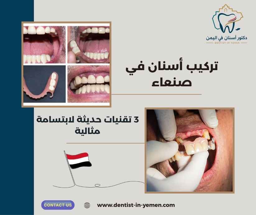 تركيب أسنان في صنعاء