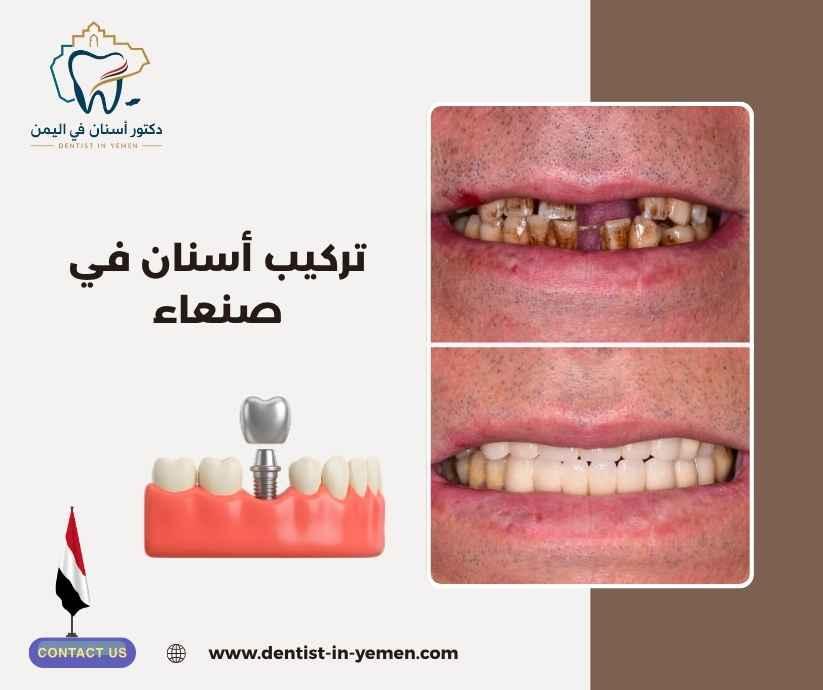 تركيب أسنان في صنعاء