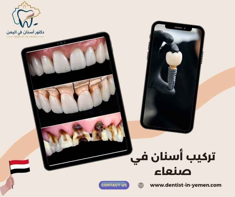 تركيب أسنان في صنعاء