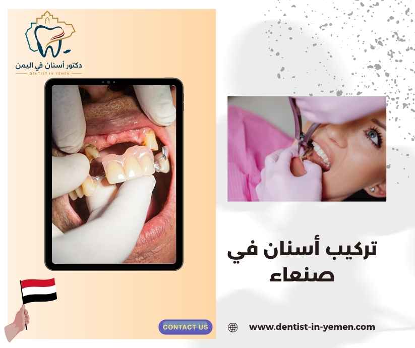 تركيب أسنان في صنعاء