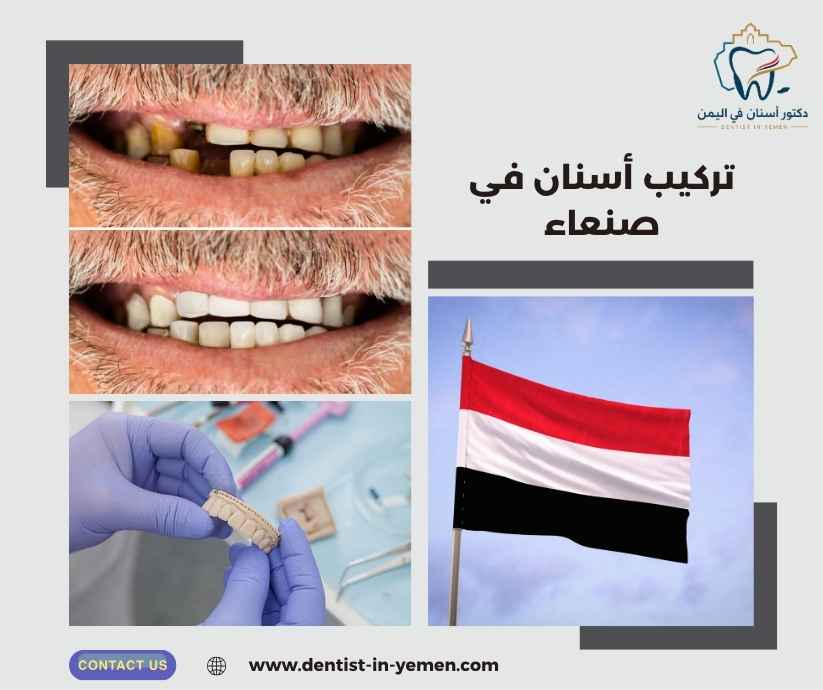 تركيب أسنان في صنعاء