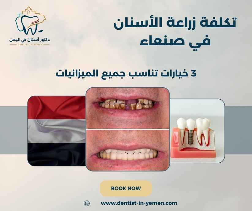 تكلفة زراعة الأسنان في صنعاء