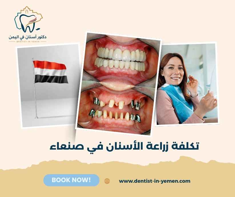 تكلفة زراعة الأسنان في صنعاء