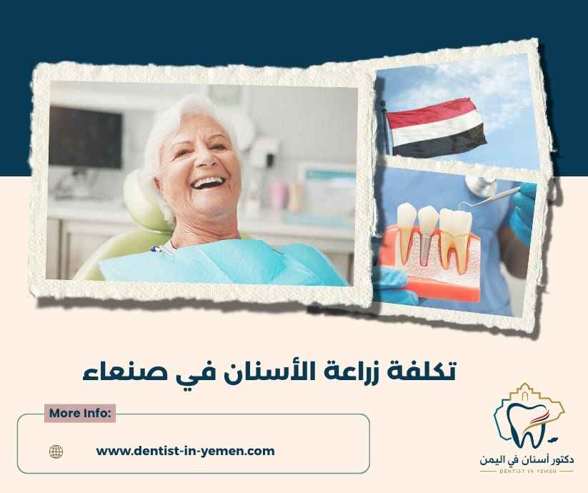 تفاصيل تكلفة زراعة السن الواحد