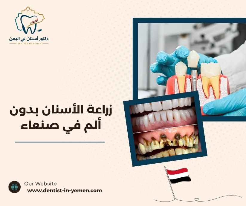 زراعة الأسنان بدون ألم في صنعاء 