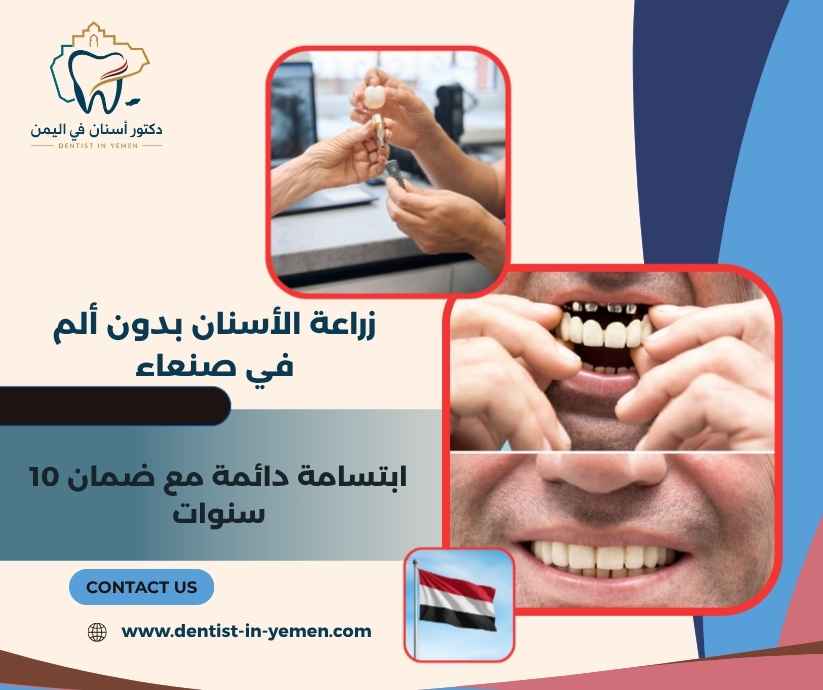 زراعة الأسنان بدون ألم في صنعاء