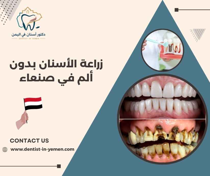 زراعة الأسنان بدون ألم في صنعاء 