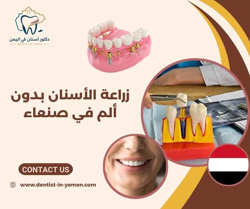 زراعة الأسنان بدون ألم في صنعاء 
