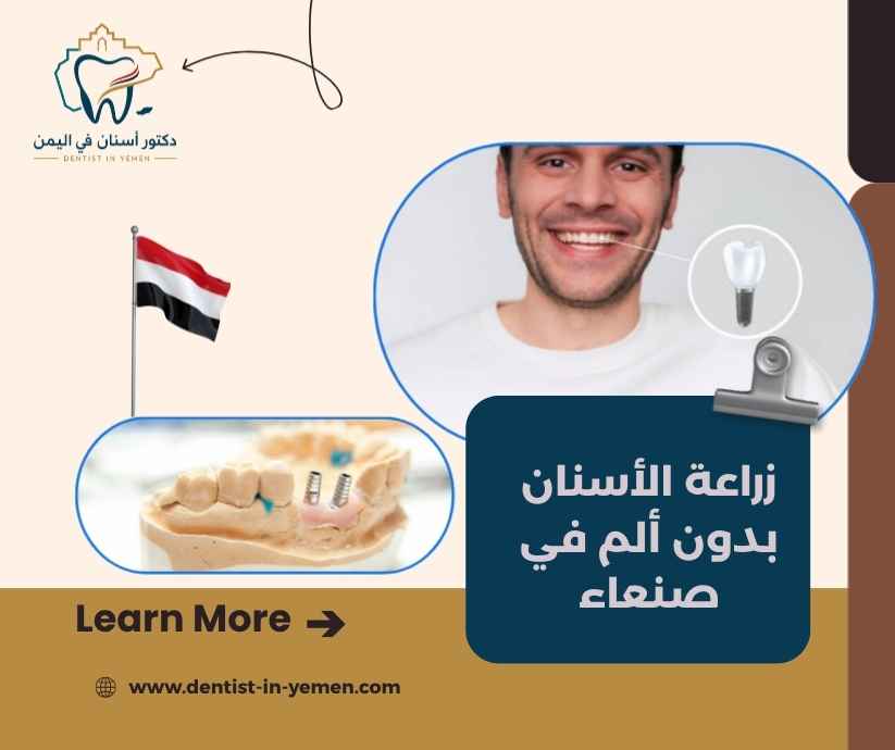 زراعة الأسنان بدون ألم في صنعاء 