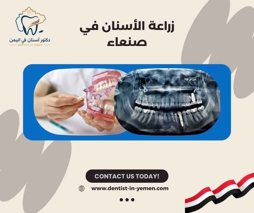 زراعة الأسنان في صنعاء 