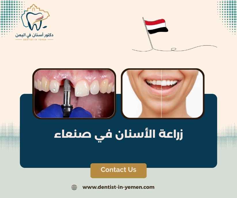 زراعة الأسنان في صنعاء 
