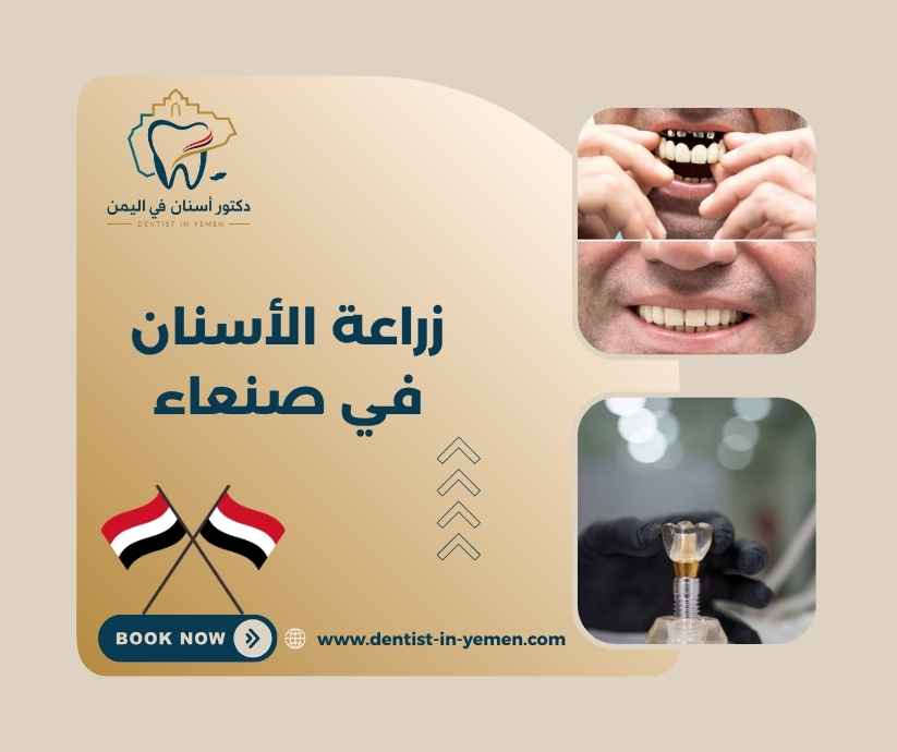 زراعة الأسنان في صنعاء 