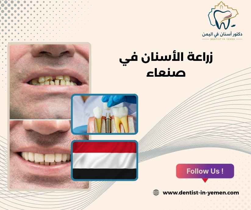 زراعة الأسنان في صنعاء 