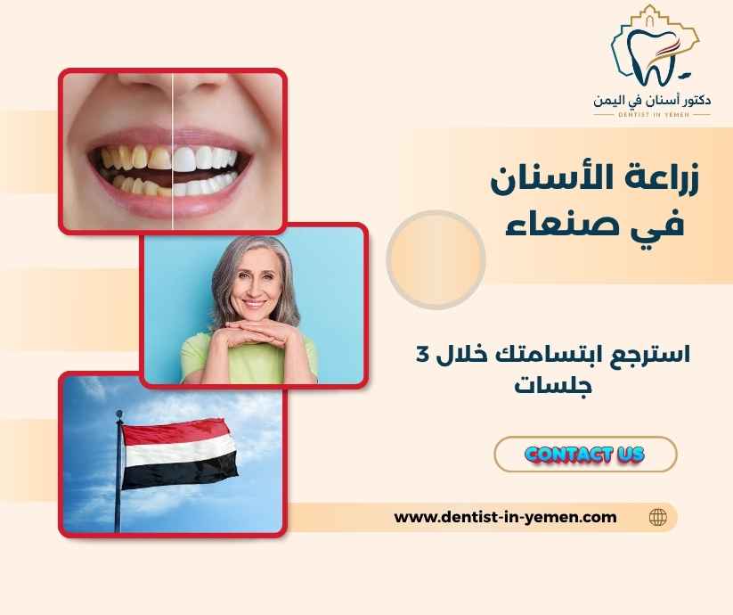 زراعة الأسنان في صنعاء